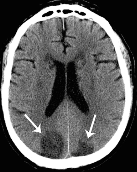 Oliver Segal AF and stroke CT stroke.jpeg