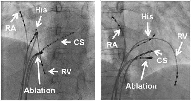 Oliver Segal SVT treatment AVNRT.jpeg