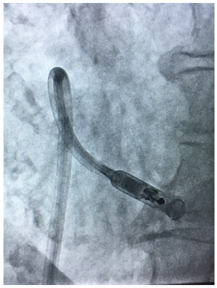 Oliver Segal Implant lead.png