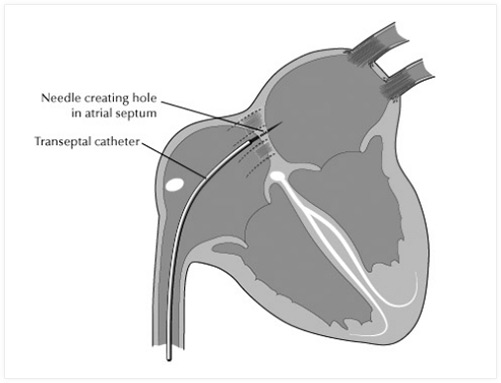 Oliver Segal transseptal catheter.jpg