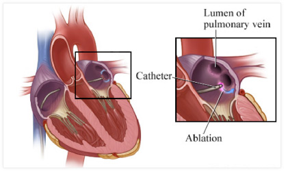 Oliver Segal Pulmonary Vein Isolation.jpg