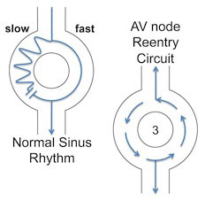 Oliver Segal AVNRT AV reentry circuit.jpg