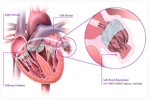 Oliver Segal Watchman Implant procedure.jpg