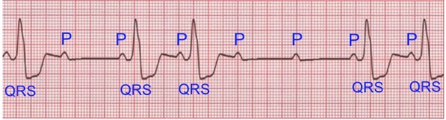 Oliver Segal Bradycardia Heart block.jpeg