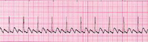 Oliver Segal ECG of Atrial Flutter.jpg