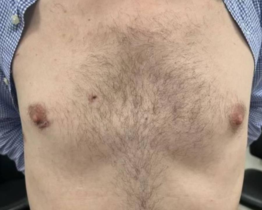 Endoscopic Cardiac surgery minimal scarring male