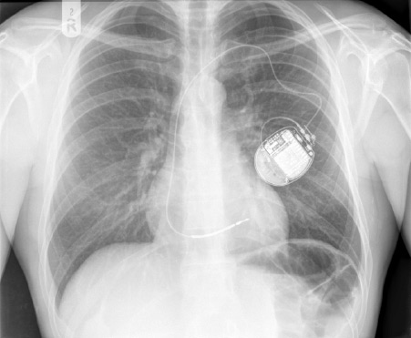 ICD implanted