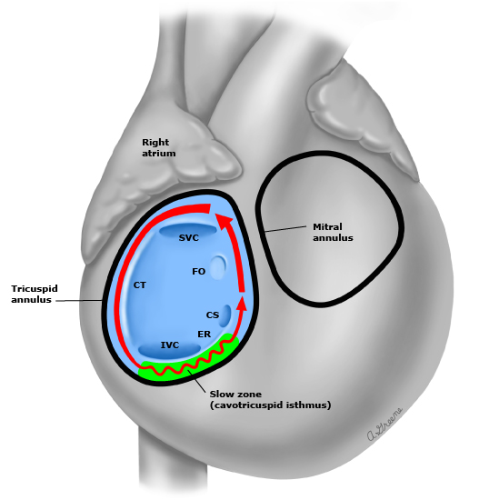 Oliver Segal Flutter circuit rotating right atrium.jpeg