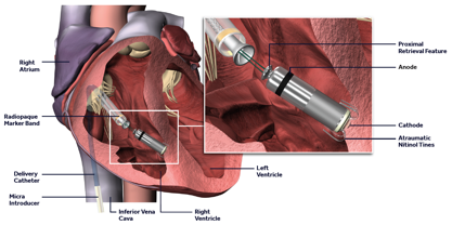 Oliver Segal The Medtronic Micra Leadless pacemaker.png