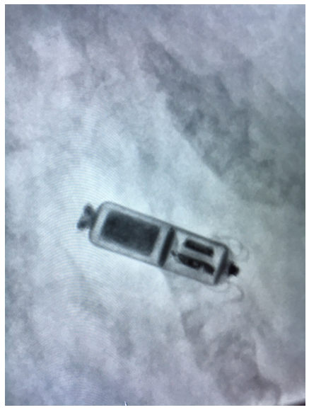 Oliver Segal implanted pacemaker.png