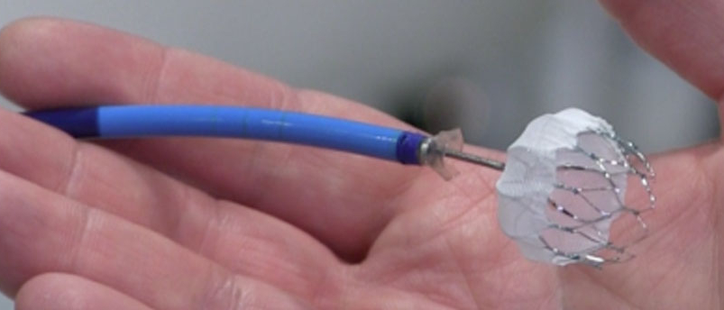 Oliver Segal Risk of device implantation  watchman.jpg