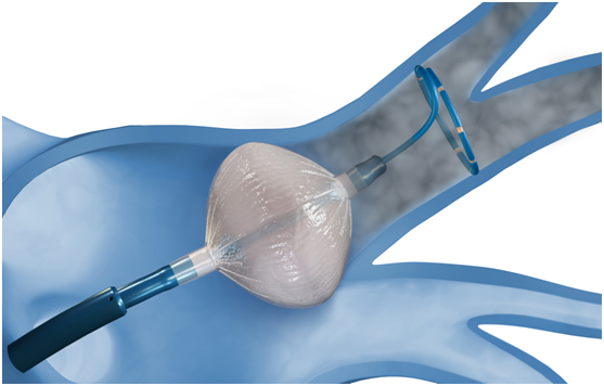 Oliver Segal What happens with Warfarin af-ablation.jpg