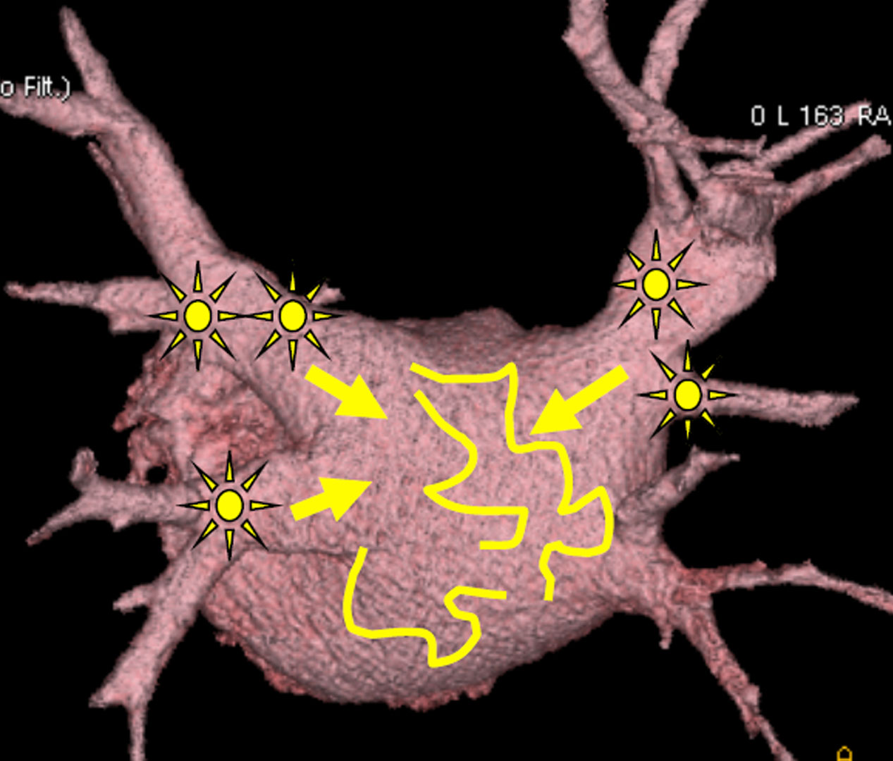 Oliver Segal Paroxysmal or intermittent AF 3d image.jpg